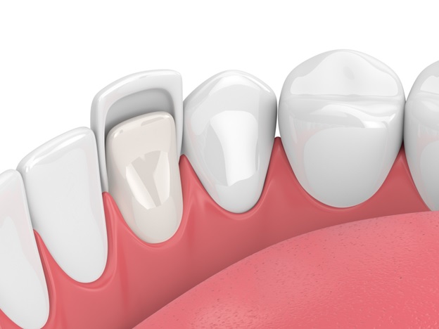 3 Factors to Consider Before Getting Veneers